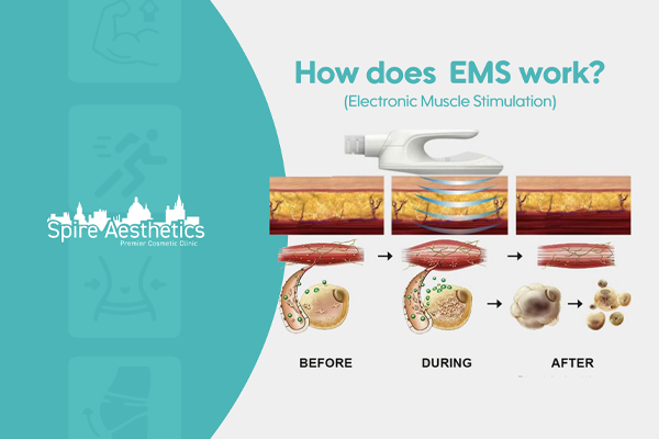 EMS treatment for post pregnancy weight loss treatment East Tilbury