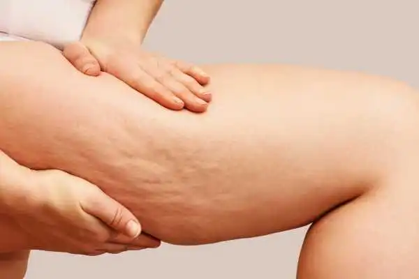 Image of woman showing leg with cellulite East Tilbury