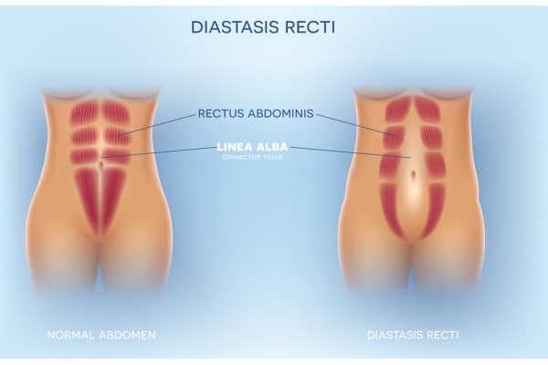 How Does Non-Surgical Treatment Help With Loose Skin, Weak Abdominal Muscles and Post-Pregnancy Changes East Tilbury?