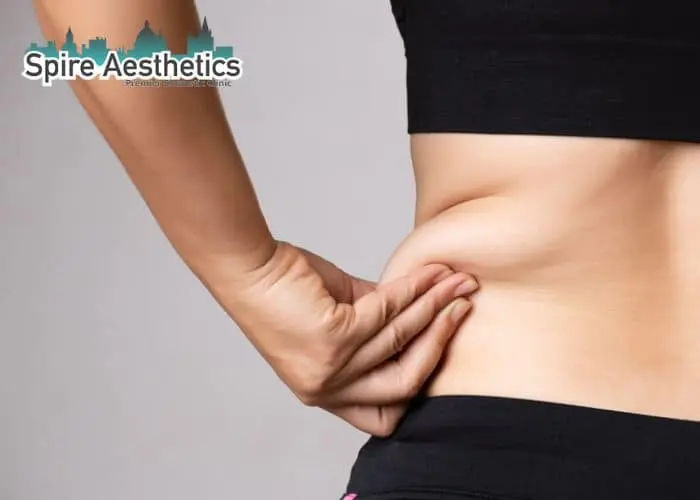 Image of woman pinching fat on their hips East Tilbury. Fat Freezing treatment 