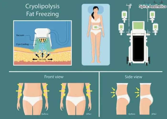 Fat freezing treatment East Tilbury benefits for competitions to remove stubborn fat deposits.