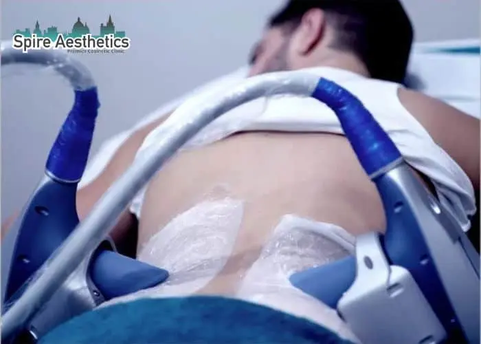 Man having fat freezing treatment done on love handles before a competitions East Tilbury to create a sculpted look.