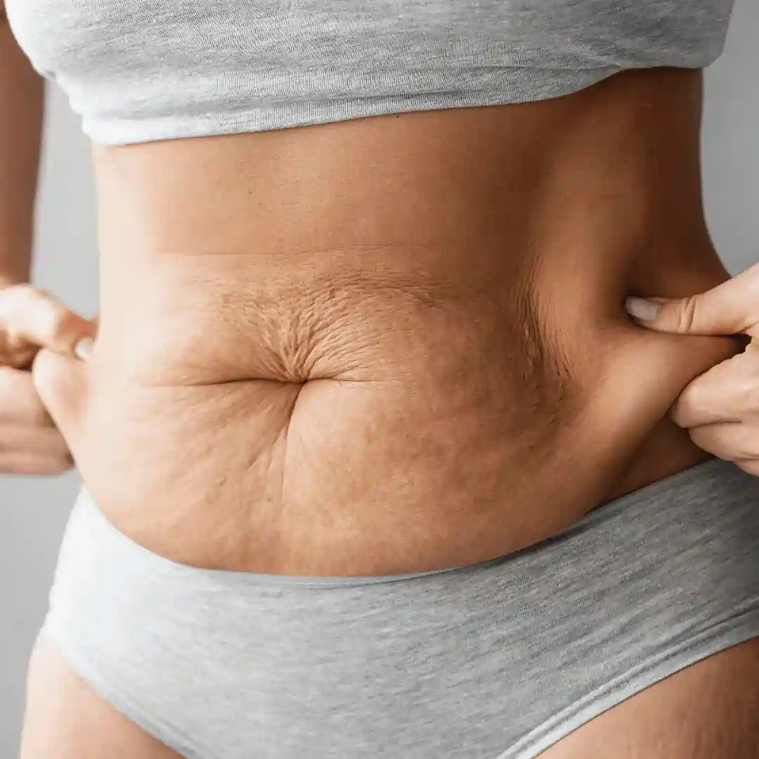 Is It Normal to Have Loose Skin After Pregnancy East Tilbury?