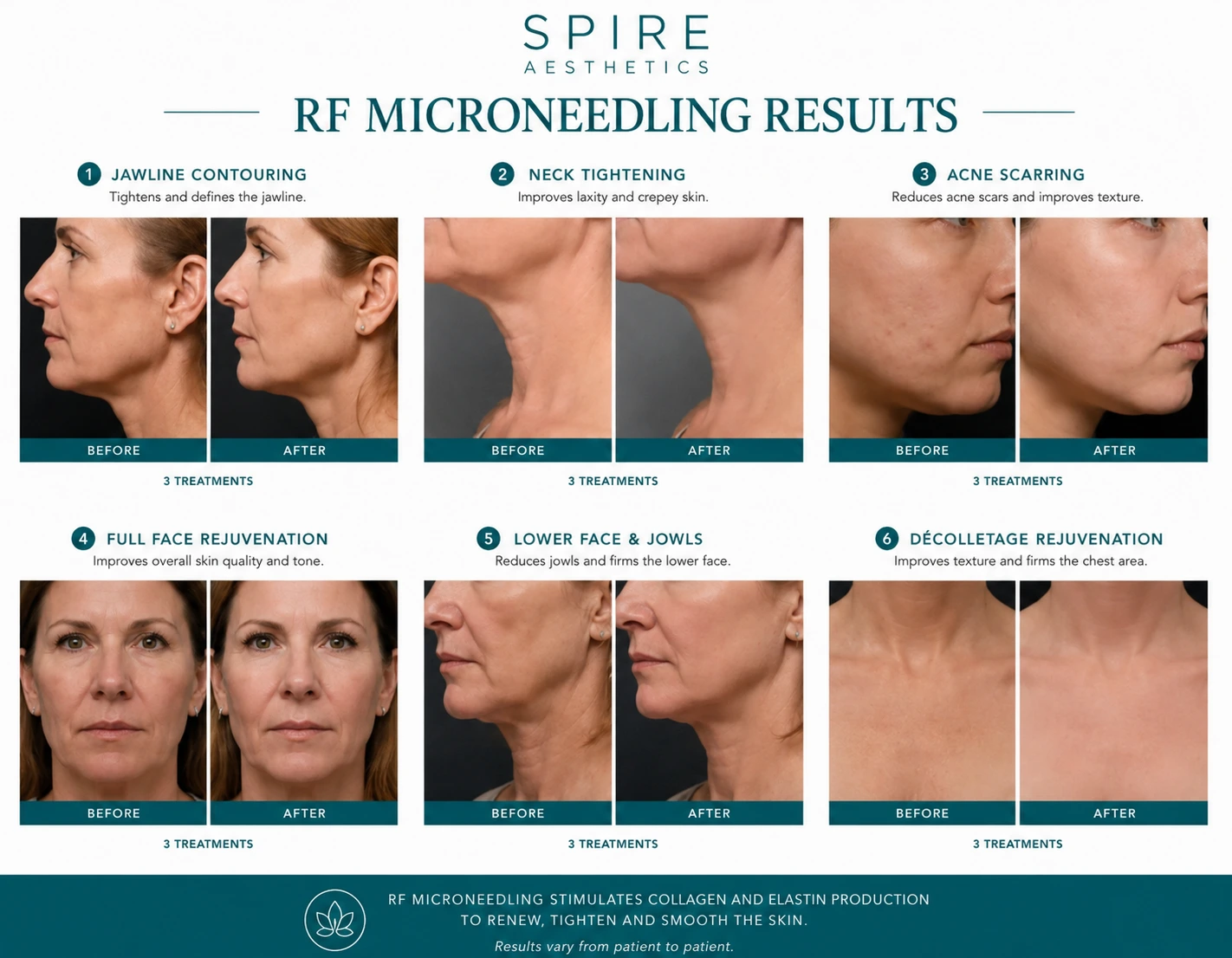 RF Microneedling Skin tightening East Tilbury results