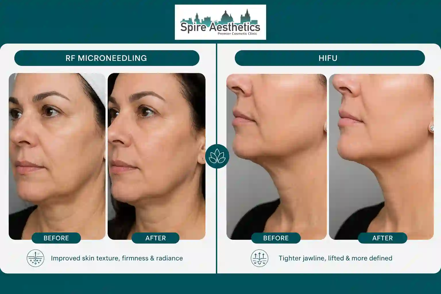 Can RF Microneedling and HIFU Be Combined East Tilbury?