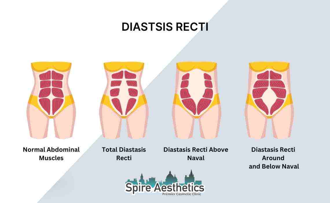 Is Non-Surgical Diastasis Recti Treatment Right for You? Common Concerns Answered East Tilbury